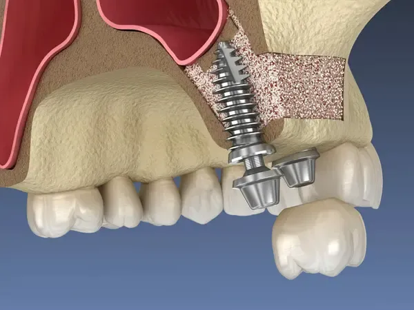 Sinus Lifting – Procedura de Creștere a Volumului Osos pentru Implanturi Sigure