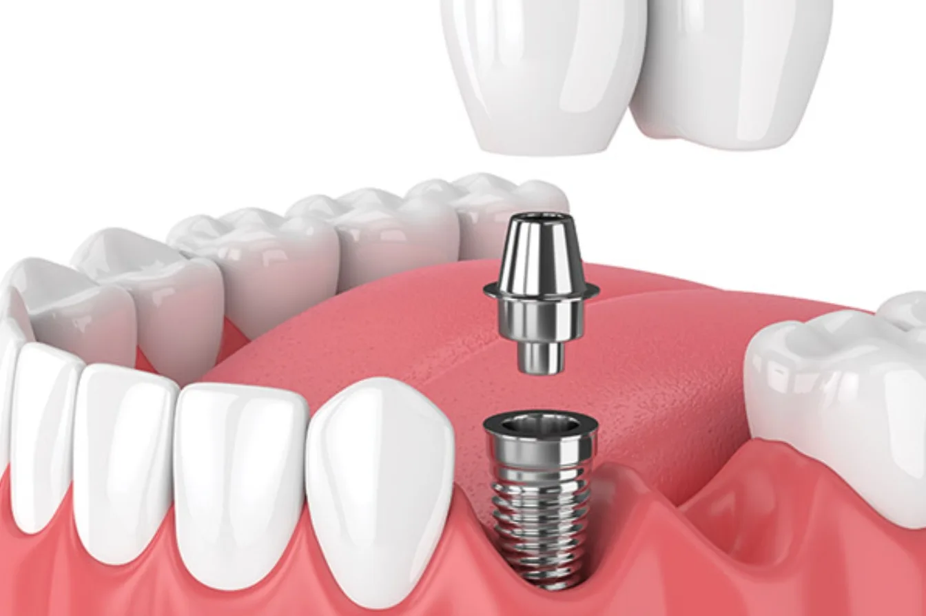 Implanturi dentare: ce variante există și care este cea mai potrivită pentru cazul dumneavoastră?