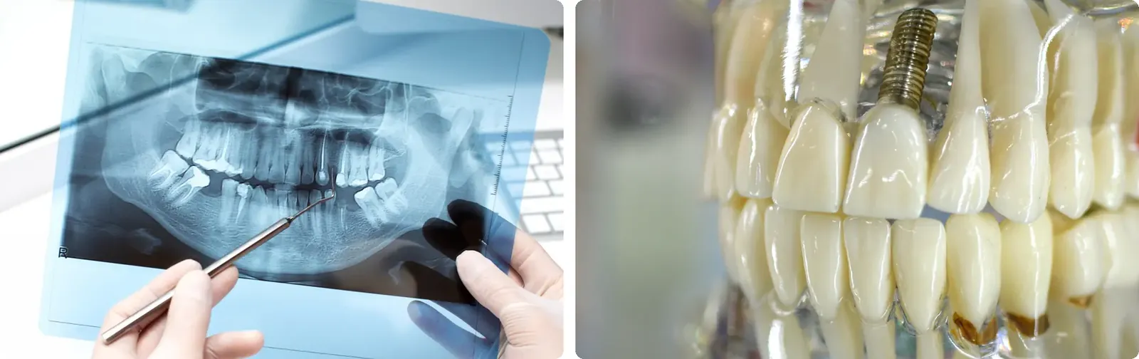 Radiografia panoramică și modelul cu implant